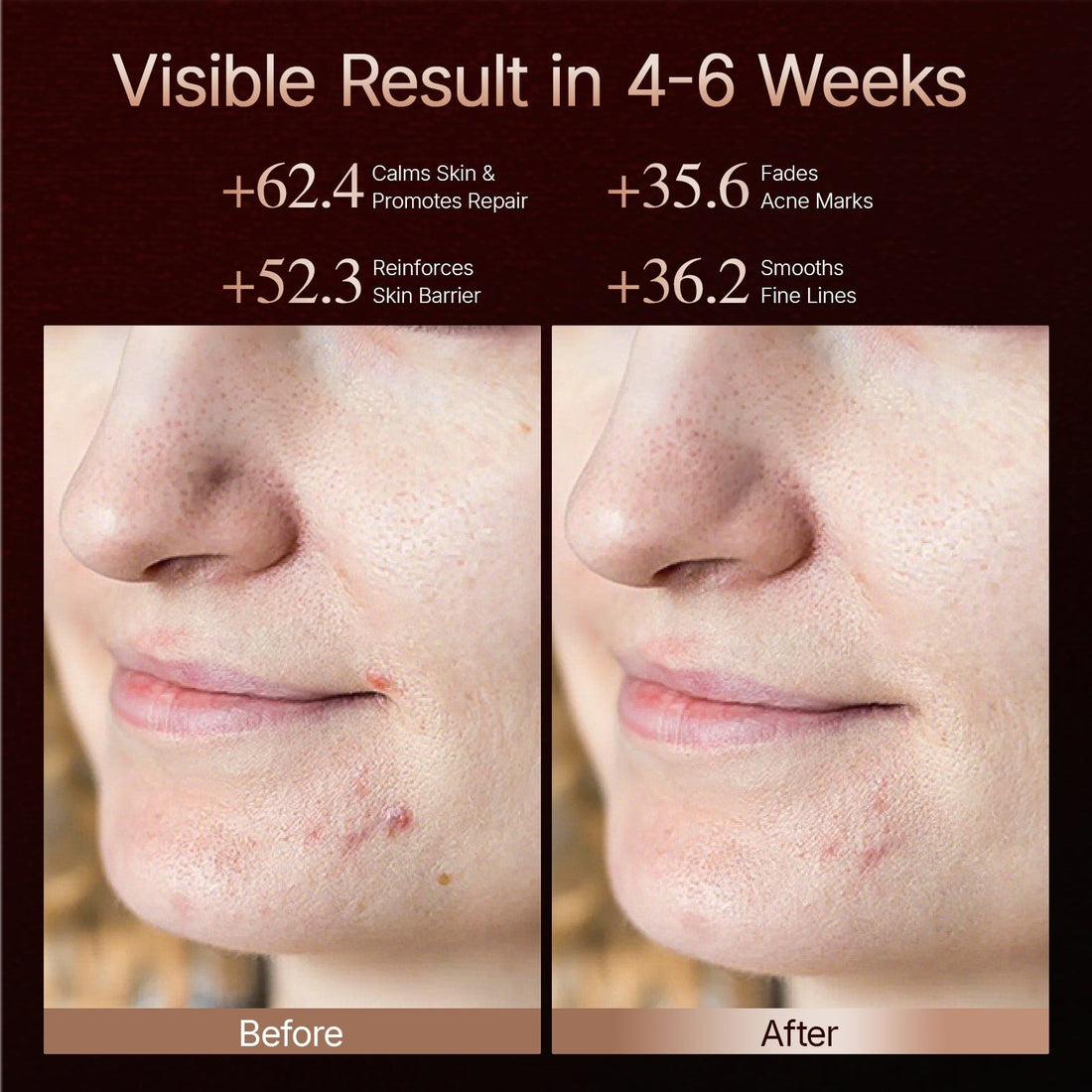 Before and after skin comparison showing visible reduction in inflammatory acne and improved skin clarity after consistent use of the ELEVAURE 4D Contoured LED Face Mask at 3–5 sessions per week.