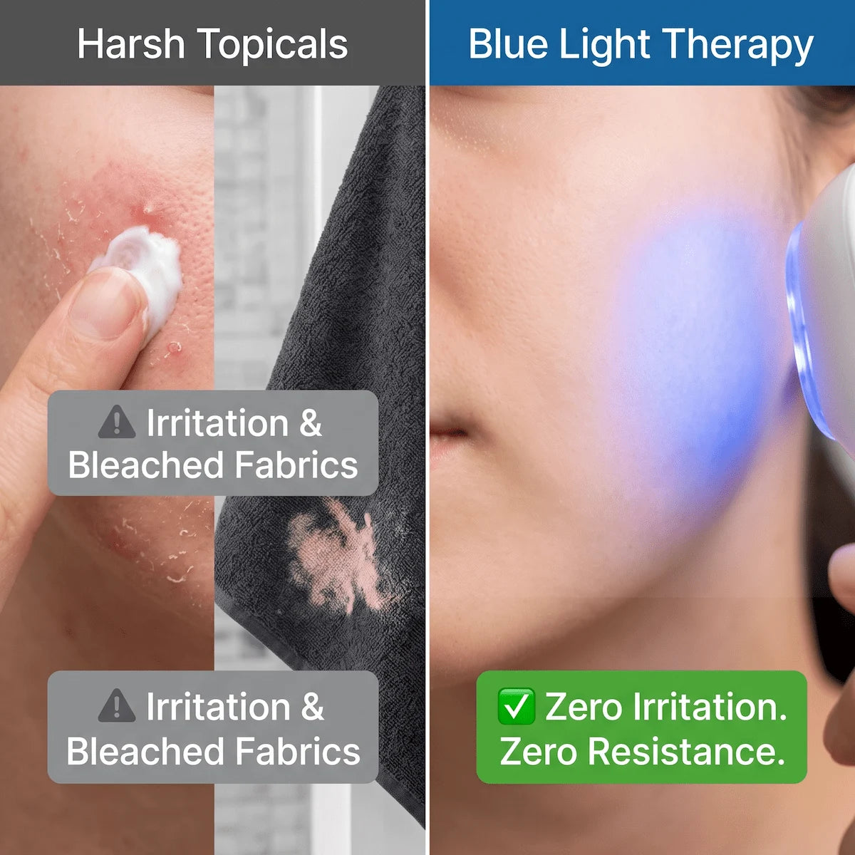 Comparison showing the irritation and peeling caused by topical acne creams versus the gentle, non-irritating effect of blue light therapy.