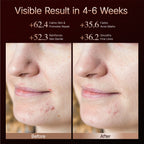 Before and after close-up of facial skin texture showing visible calming and reduced blemish marks over 4 to 6 weeks.
