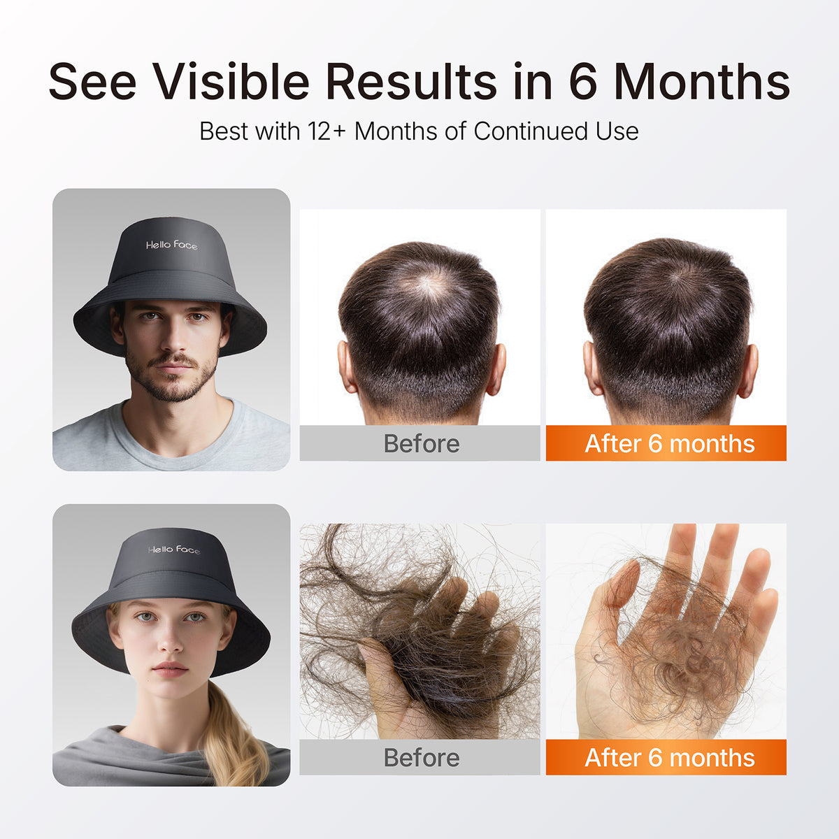 Before and after 6 months results showing fuller crown density and reduced daily hair shedding with red light therapy cap