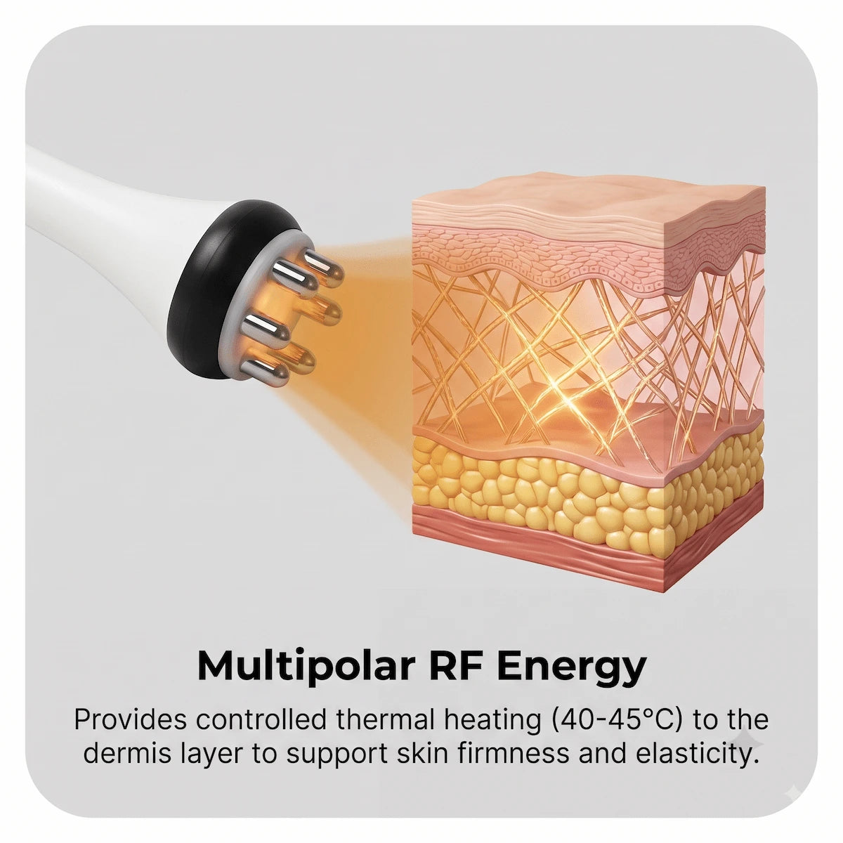 3D representation of multipolar radio frequency delivering controlled thermal energy to the dermis layer.