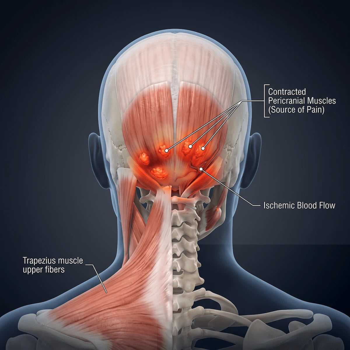 3D anatomical illustration showing contracted pericranial muscles and restricted blood flow that cause tension headaches.