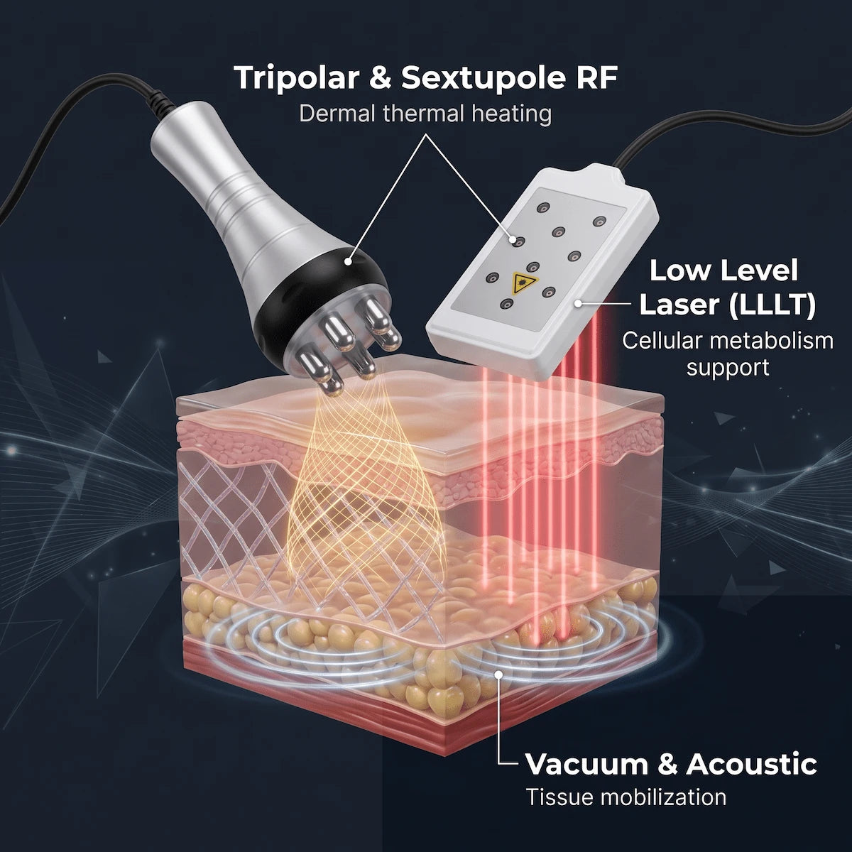 3D conceptual diagram showing RF thermal energy, acoustic cavitation, and LLLT acting on skin and fat tissue layers.