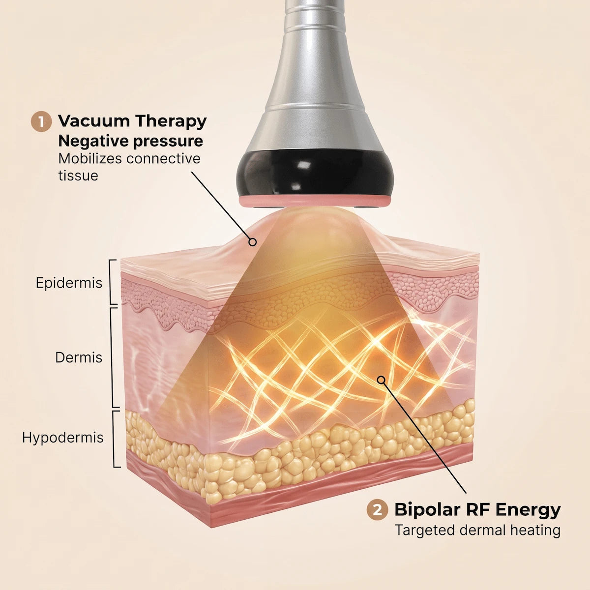 3D diagram illustrating vacuum therapy and bipolar RF energy acting on dermal connective tissue.