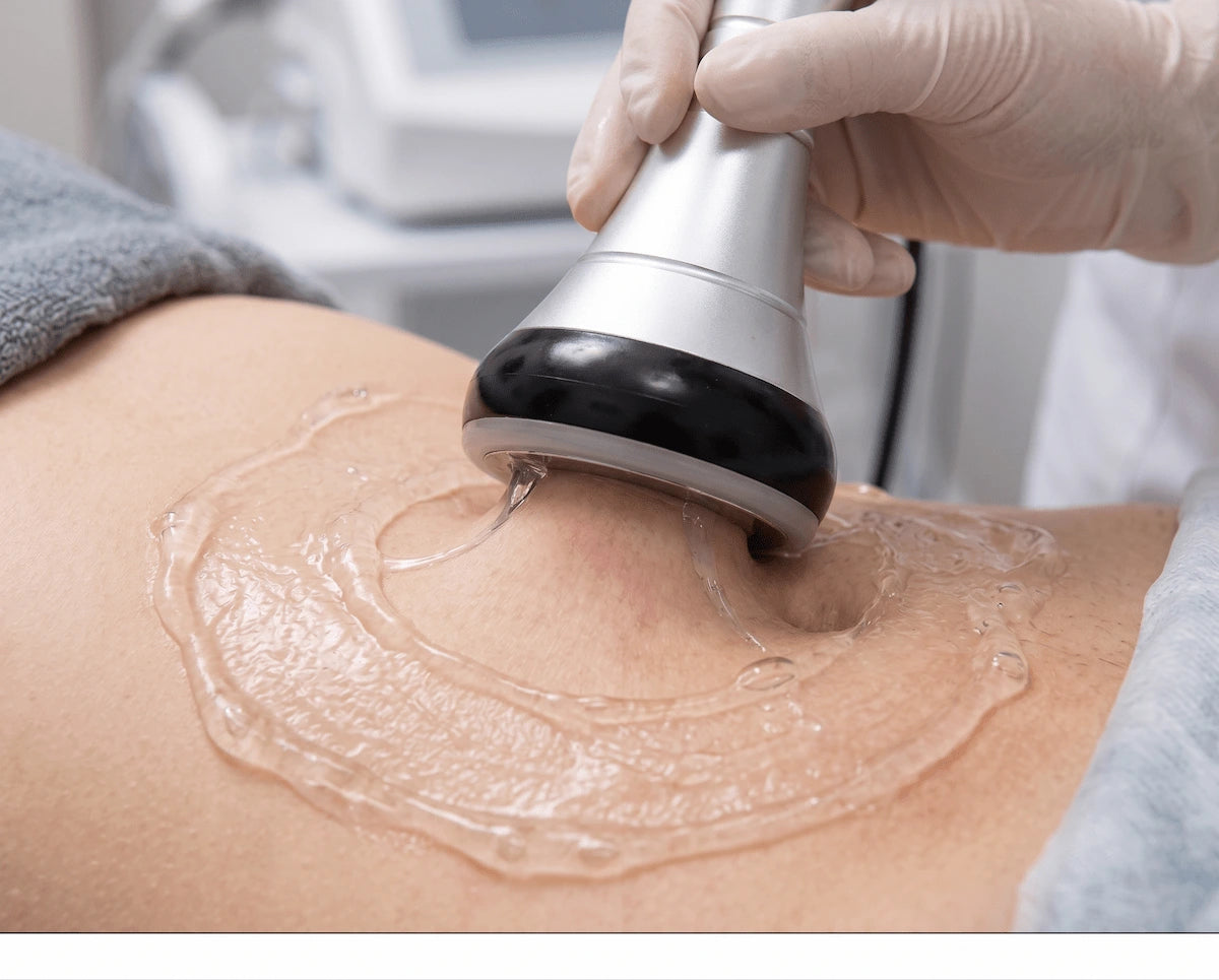Gliding the vacuum bipolar RF handle in upward spiral motions on the thigh.