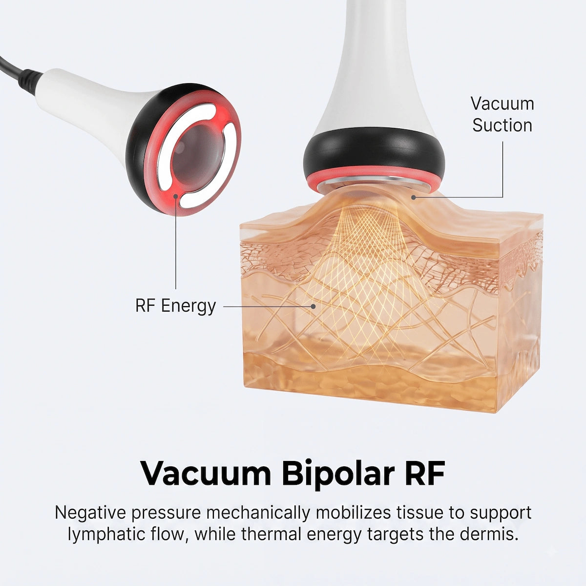 3D diagram illustrating the mechanism of vacuum bipolar RF lifting connective tissue and supporting the dermis.
