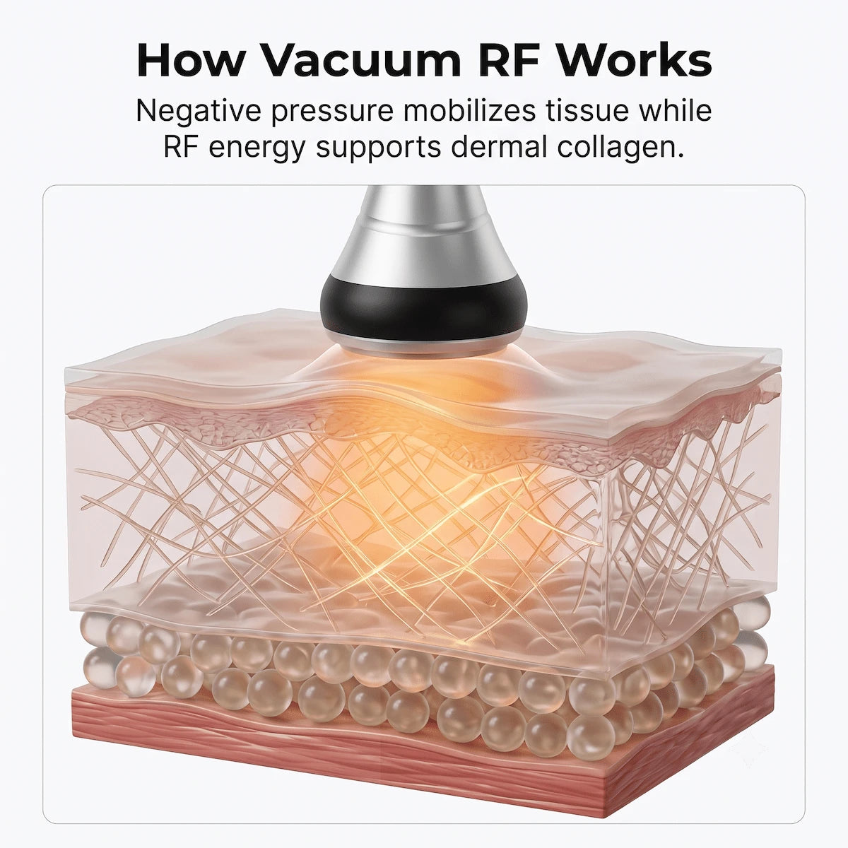 3D diagram illustrating vacuum suction and RF thermal energy acting on dermal connective tissue and collagen layer